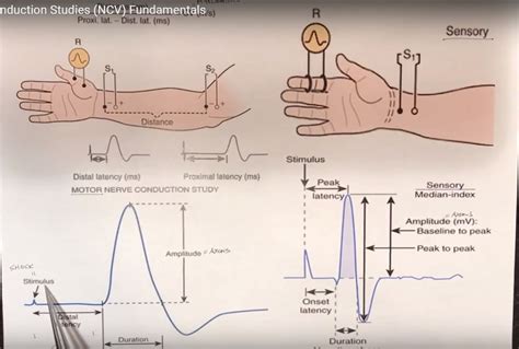 test for nerve compression|examples of nerve conduction studies.